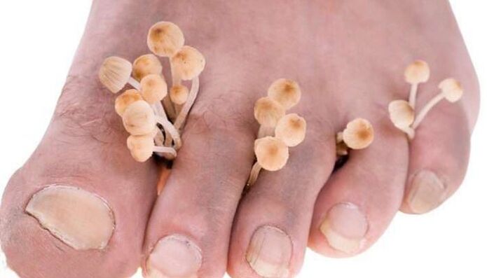 fungus between toes