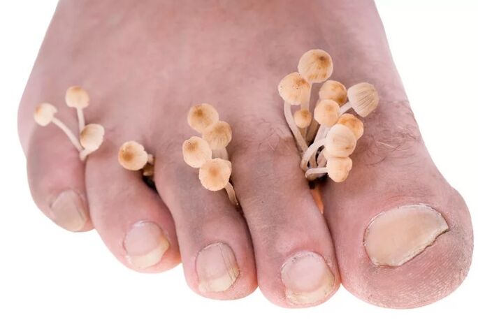The fungus of the feet