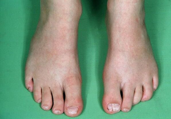 The fungus on the legs