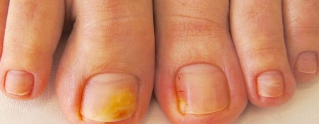 Nail fungus