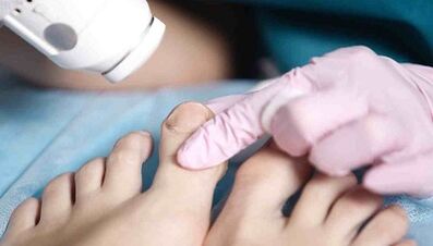 Fungal hardware treatment on the legs