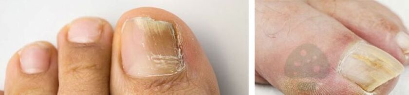 The fungus of the thumb nail on the leg