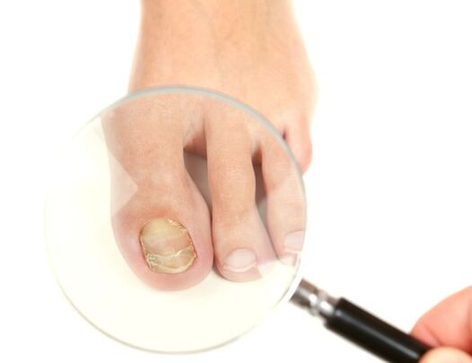 nail fungus