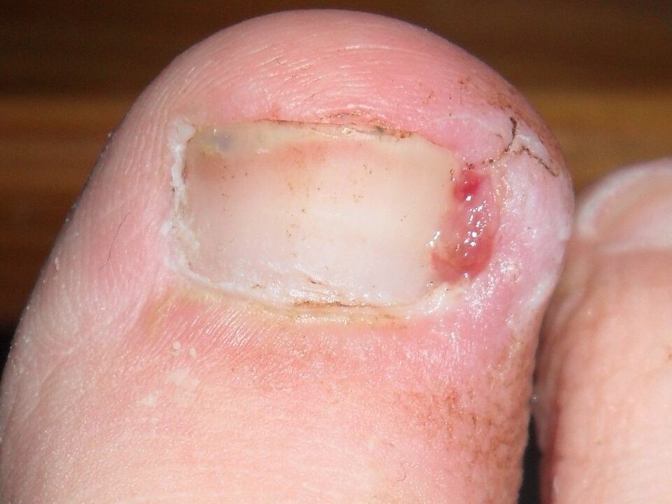 ingrown toenail as a symptom of fungal infection