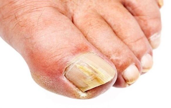 Onychomycosis - nail fungus
