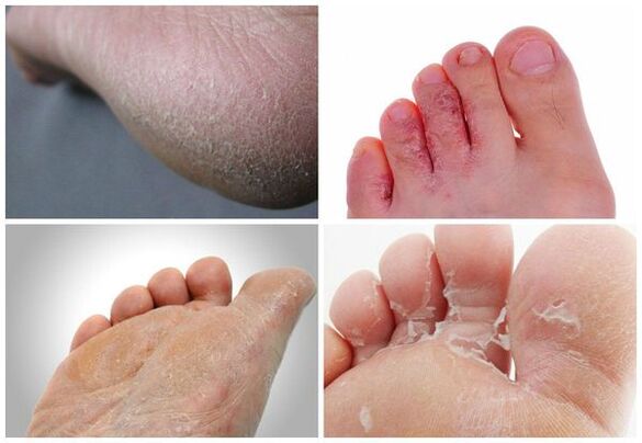 The main manifestations of foot mycosis are keratinization of the skin, cracks, peeling