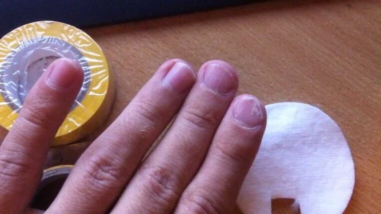 nail fungus and its treatment with folk remedies