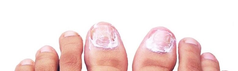 nail ointment for fungus